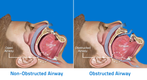 Anatomy-of-Obstructive-Sleep-Apnea